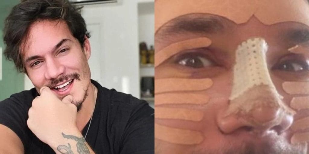 Eliezer, namorado de Viih Tube, surge com rosto cheio de curativos, sem dente e aparência assusta