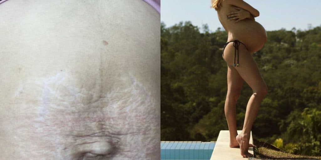 Depois de um mês do parto de gêmeos, filha do Xuxa exibe barriga após procedimentos estéticos