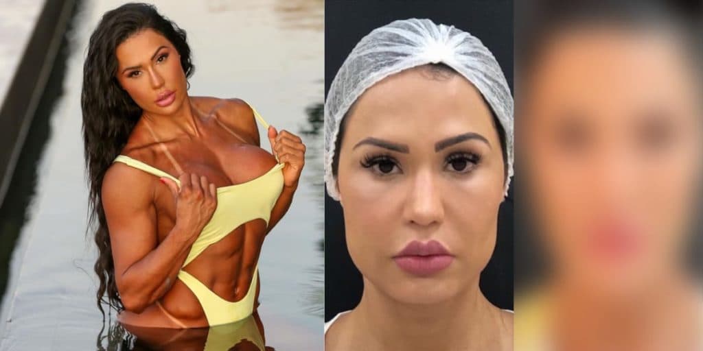 Gracyanne Barbosa passa por procedimento no rosto, mostra antes e depois e resultado choca: "Outra pessoa"