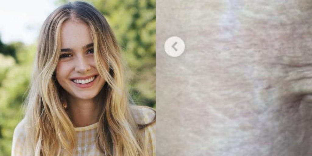 Isa Scherer, filha de Xuxa, exibe barriga um mês após parto de gêmeos e impacta com realidade: "Marcas"