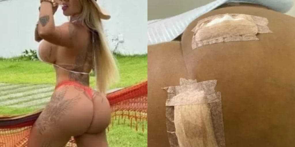 Famosa faz cirurgia em clínica clandestina e procedimento dá completamente errado: "Pior parte é aparência"