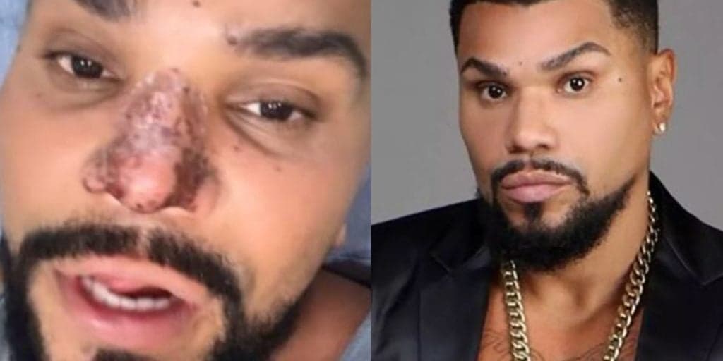 Naldo Benny tem nariz tomado por necrose e fica à beira de perdê-lo após procedimento errado em clínica