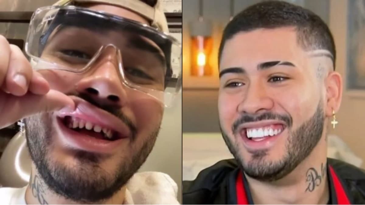 MC Kevinho antes e depois das lentes nos dentes (Reprodução) MC Kevinho antes e depois das lentes nos dentes (Reprodução)