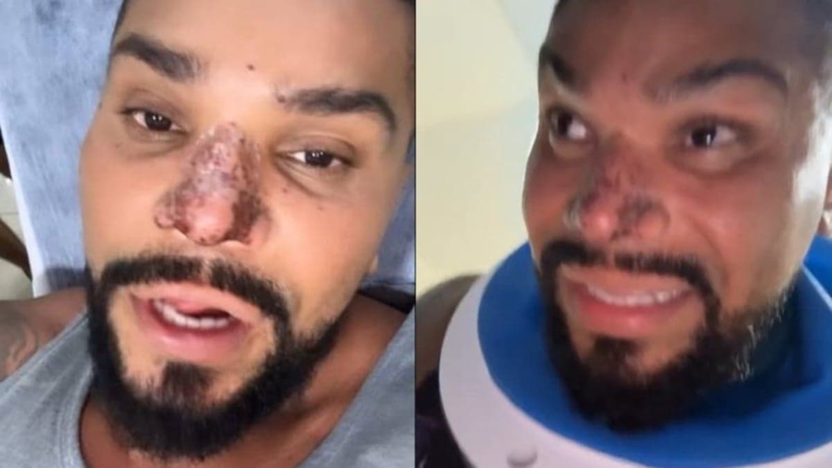 Naldo Benny está com parte do rosto deformado por causa de uma rinomodelação que não deu certo (Foto: Reprodução / Instagram)