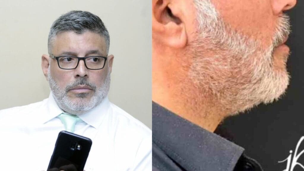 Após declarar falência, Alexandre Frota faz harmonização caríssima, radicaliza o rosto e causa revolta