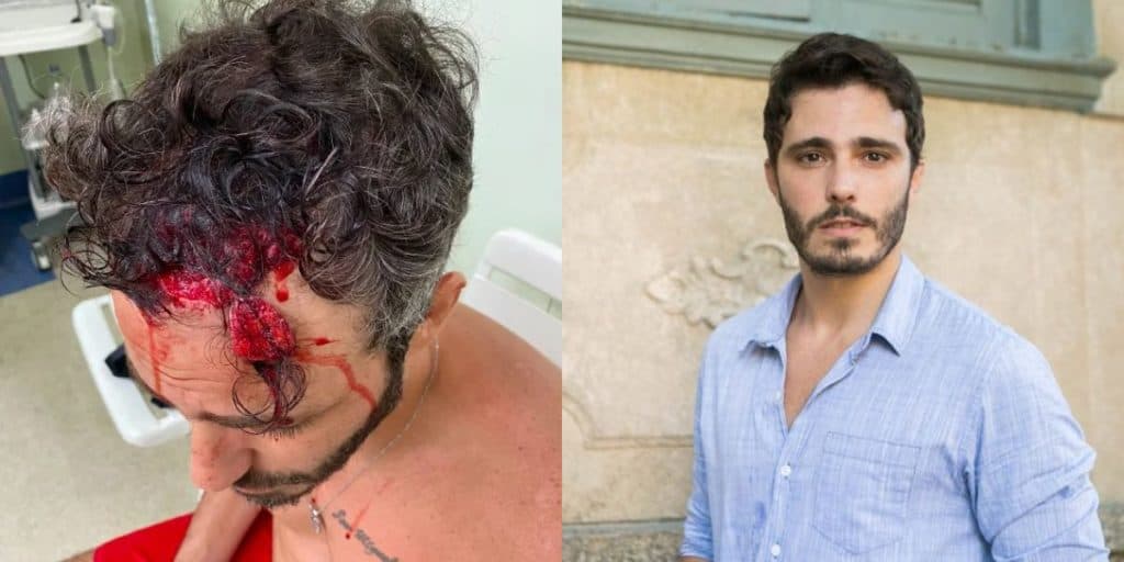 Espancado cruelmente na rua, Thiago Rodrigues está em choque ao ter parte do couro cabeludo arrancado