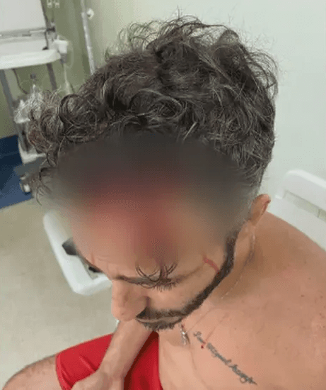 Machucado na cabeça de Thiago Rodrigues (Foto: Divulgação)