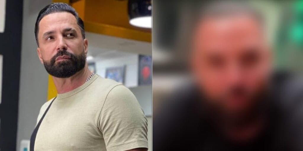 Latino fica com rosto "desfigurado" após procedimento e se assusta ao se olhar no espelho: "Tem que ficar feio"