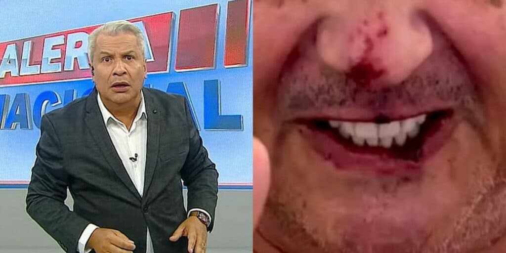 Sikêra Jr. faz aparição após ficar em estado grave na UTI e foto com rosto cheio de roxos é divulgada