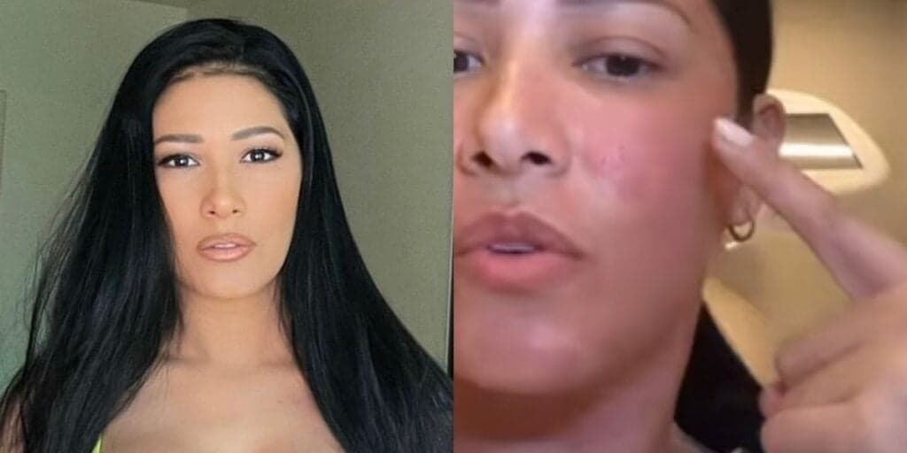 Simaria, após fase conturbada, surge com rosto inchado, vermelho e assusta: “Eu disse a vocês”