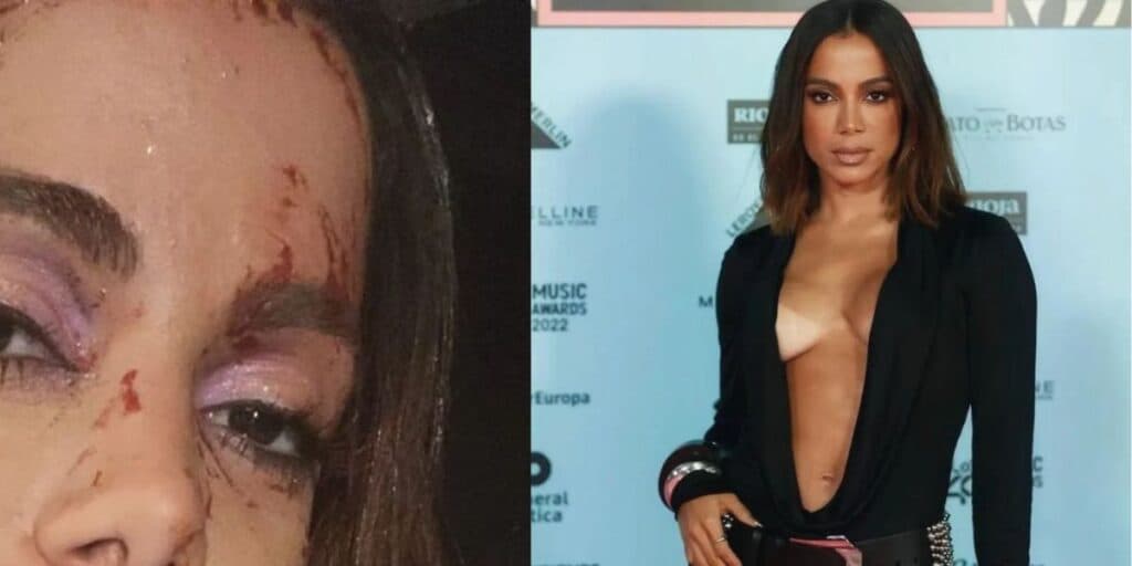 Anitta surge 'ensanguentada' e foto divulgada assusta: "O que eu fiz?"