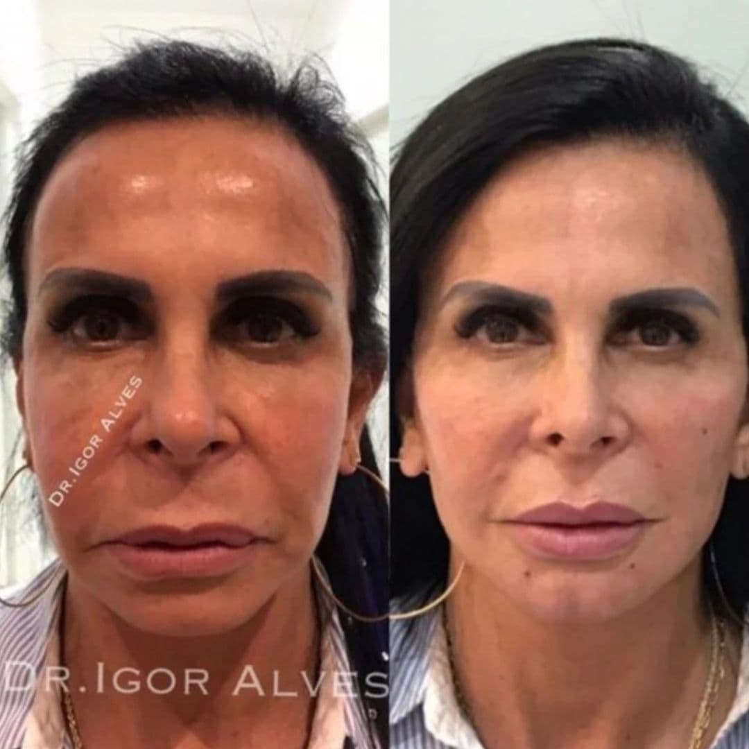 Gretchen surpreendeu os fãs ao aparecer 20 anos mais nova (Reprodução - Instagram)