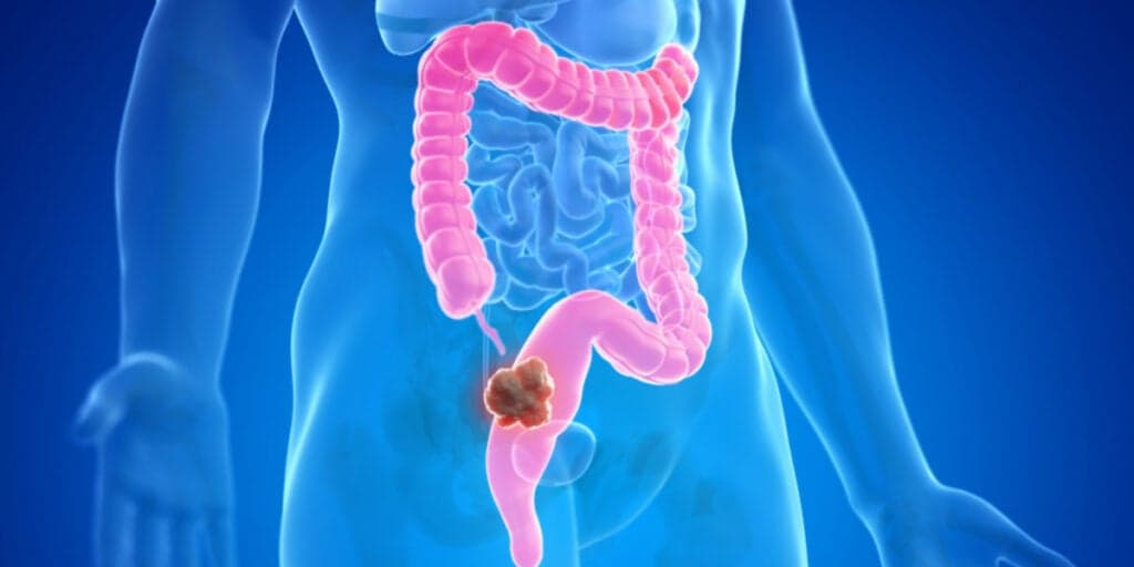 Você está sentido algum deles? Esses são os três principais sintomas para câncer no intestino