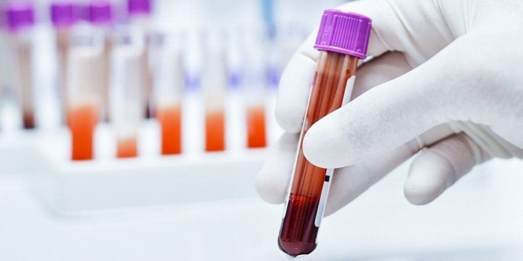 DESCOBRIMOS: O motivo revelador e importante pelo qual os exames de sangue devem ser feitos em JEJUM