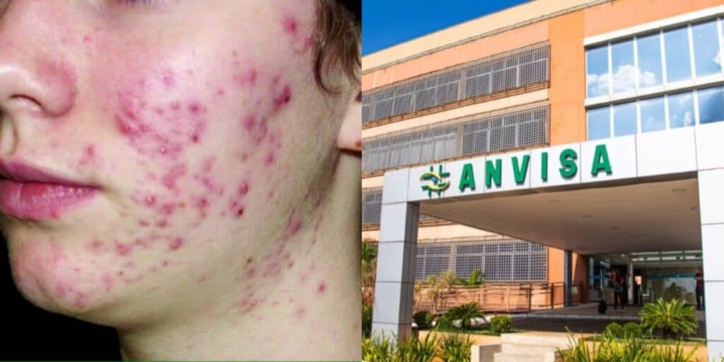 Aumento de espinhas: Anvisa baixa o facão e proibição em 5 produtos queridinhos de marca após descoberta