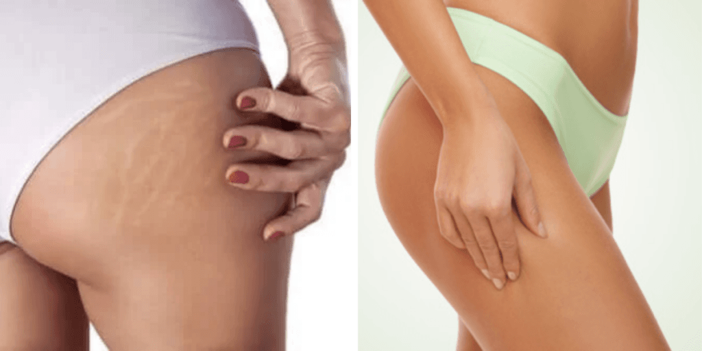 Aprovado pela ANVISA e dá fim em celulites e estrias: Ingrediente secreto acaba com pesadelo de mulheres