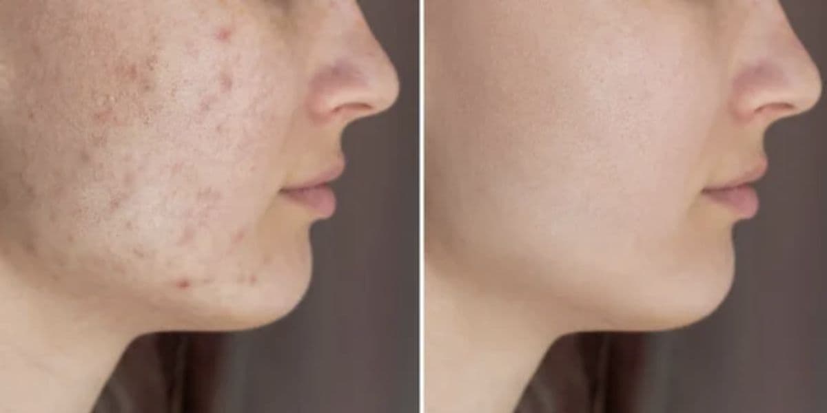 Antes e depois de manchas (Foto: Reprodução / Internet) 