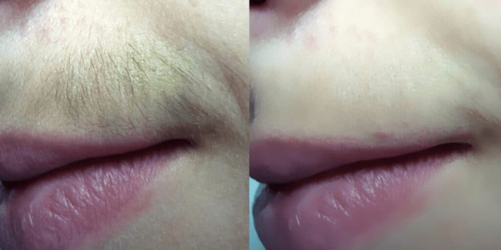Não vai mais incomodar: 3 receitas caseiras para as mulheres acabarem com o bigodinho