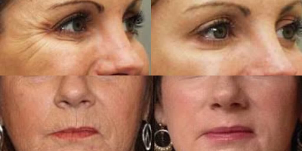 Adeus às rugas e dos 70 para os 50 anos em minutos: Receitinha de botox caseiro transformará seu rosto HOJE