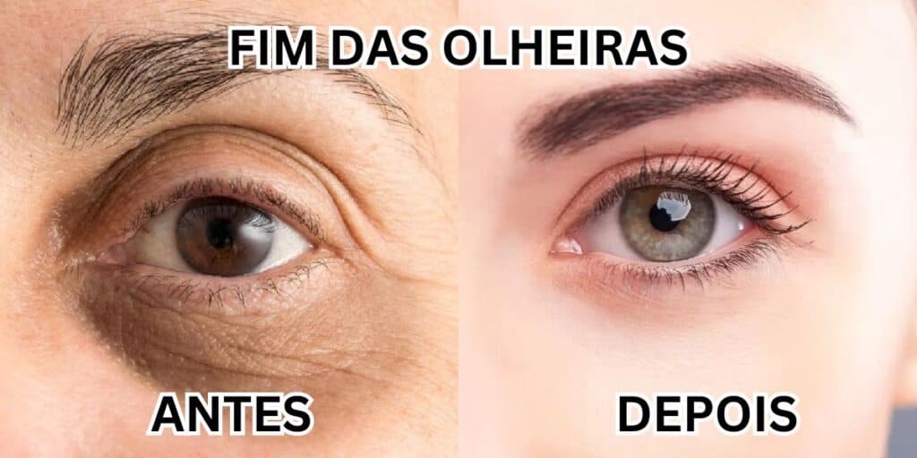 Adeus às olheiras ainda em 2023: Segredo com um único ingrediente popular vai eliminar a mancha em 2 passos