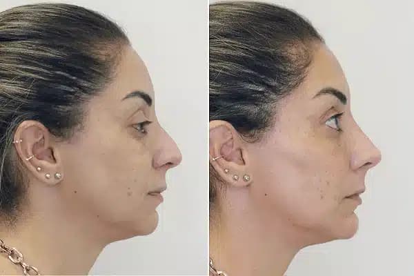 Técnica para mudar o nariz sem cirurgia plástica (Foto: Reprodução/ Internet)