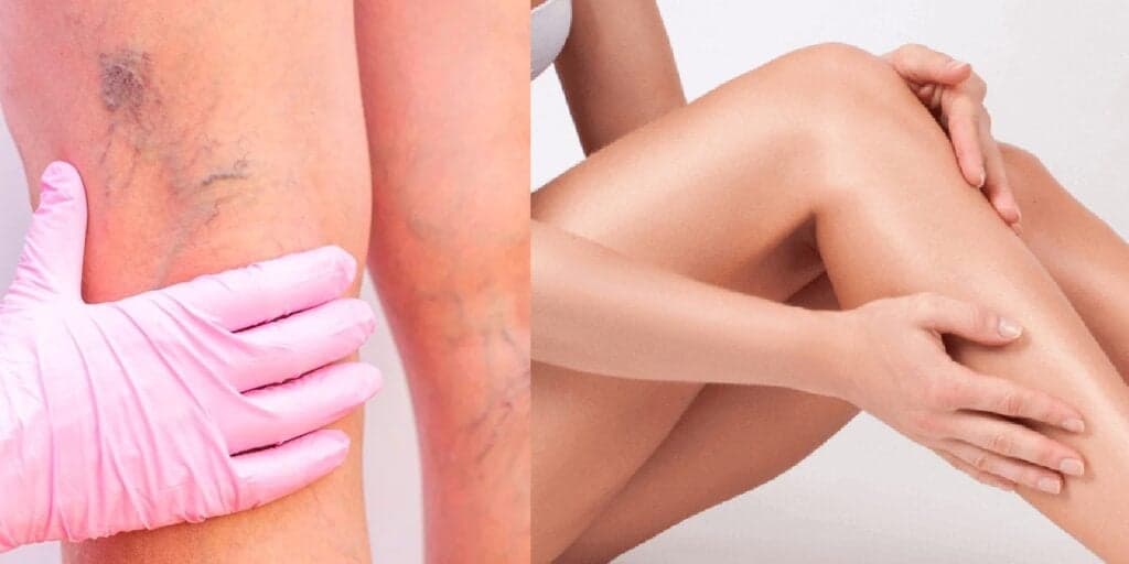 Pra voltar a usar shorts e saia no verão: 4 dicas infalíveis acabam com as varizes e deixam sua perna lisinha