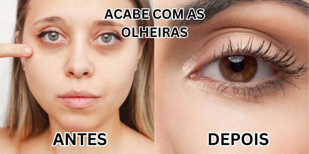 Fim das olheiras em 5 minutos: Receitinha caseira com 2 ingredientes dá adeus à mancha temida em 2 passos