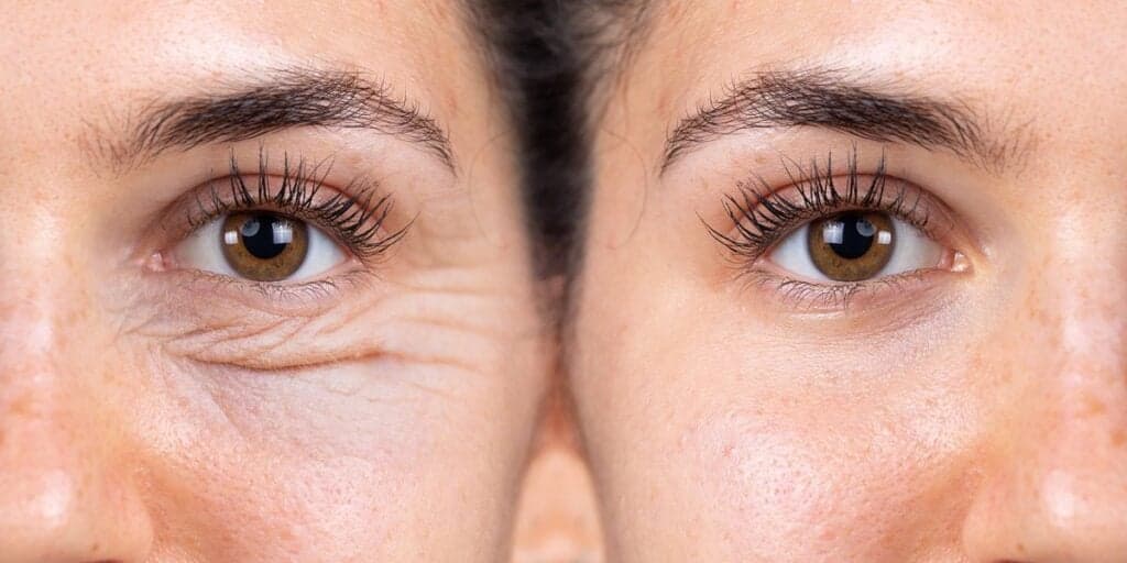Adeus do botox: Truques caseiros suga as rugas em 15 minutos e devolve a autoestima das mulheres