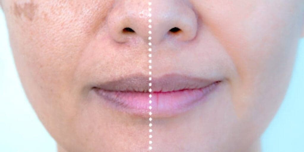 Fim das manchas e pele de porcelana: 4 receitas mágicas para clarear a pele e rejuvenescer o rosto