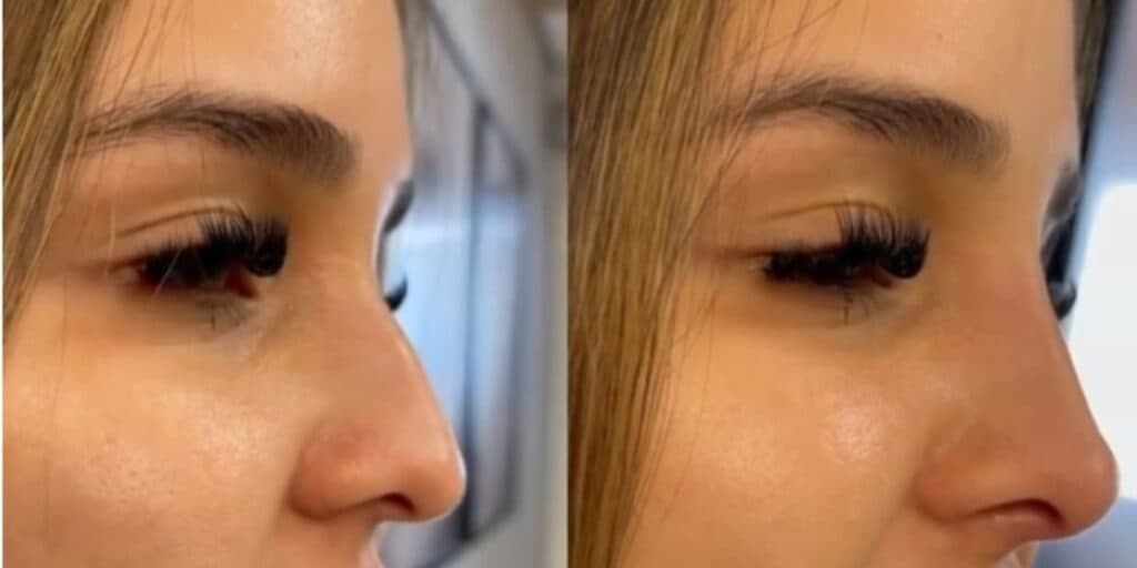 Nariz fininho sem nenhuma plástica: Técnica infalível, melhor que rinoplastia, para arrasar em 2024
