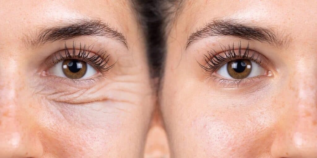Sem rugas e simetria do rosto de volta: Harmonização facial caseira fará você uma nova mulher sem gastar nada