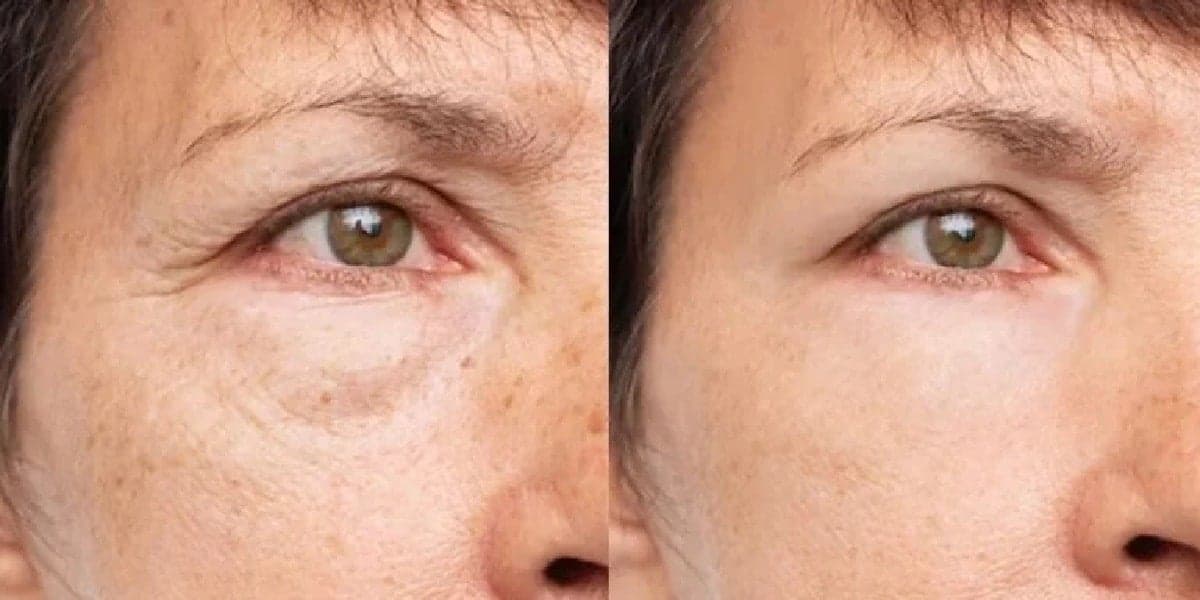 Pele com e sem rugas e manchas localizadas (Foto: Reprodução/ Internet) Pele com e sem rugas e manchas localizadas (Foto: Reprodução/ Internet)