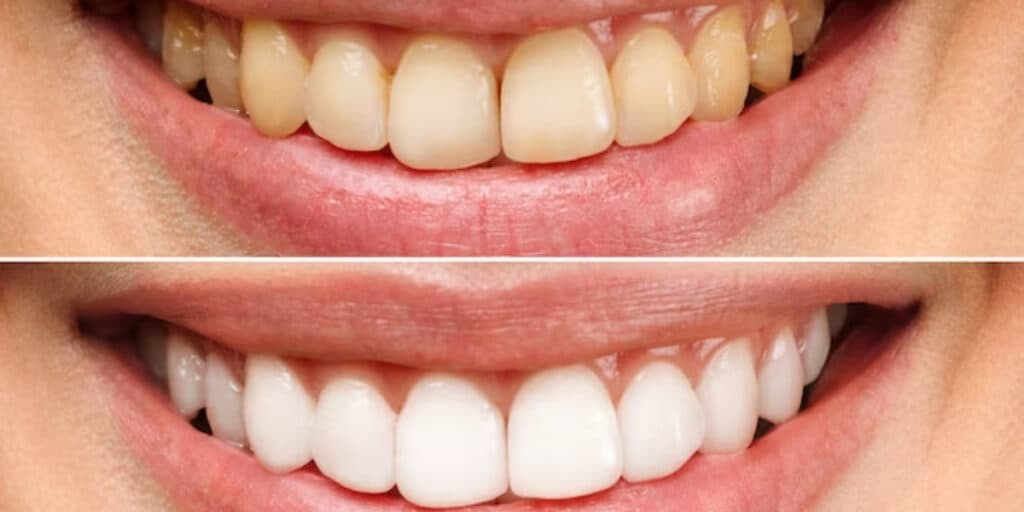 Dentes brancos e gastando muito pouco: 3 receitas milagrosas pra clarear os dentes que os dentistas escondem
