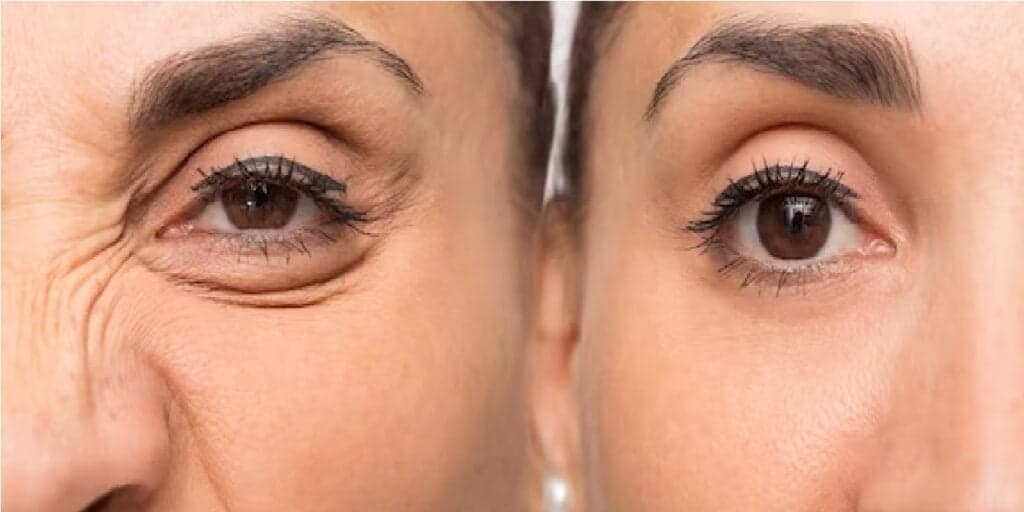 Antienvelhecimento e xô rugas profundas: Misturinha com 3 ingredientes estica a pele e rejuvenesce 30 anos