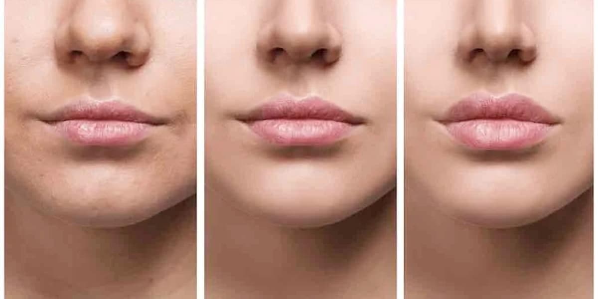 Lábios após Preenchimento labial (Foto: Reprodução, Clínica Carreirão)