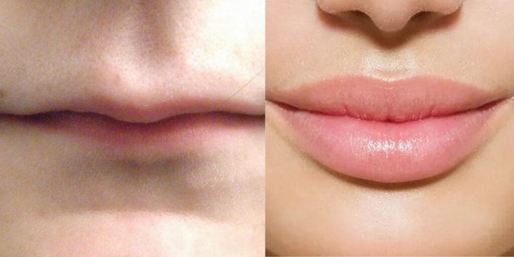 Preenchimento labial sem cirurgia: Mulheres estão ficando com a boca volumosa e definida com 5 passos em casa