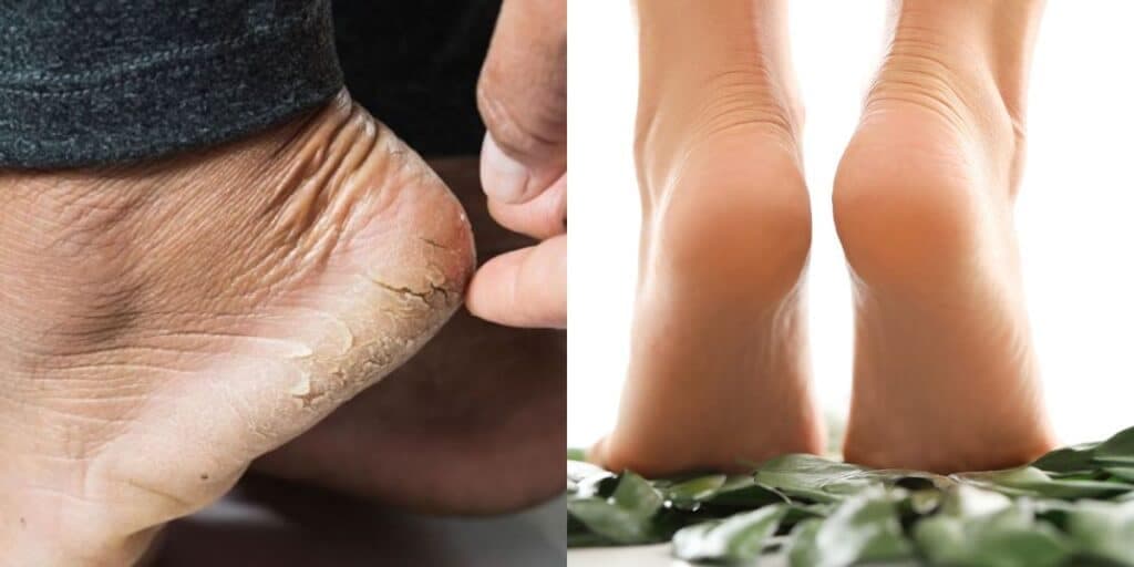Adeus pé rachado e manchas escuras: Remédio caseiro com limão e + 2 ingredientes pra ressuscitar a pele morta