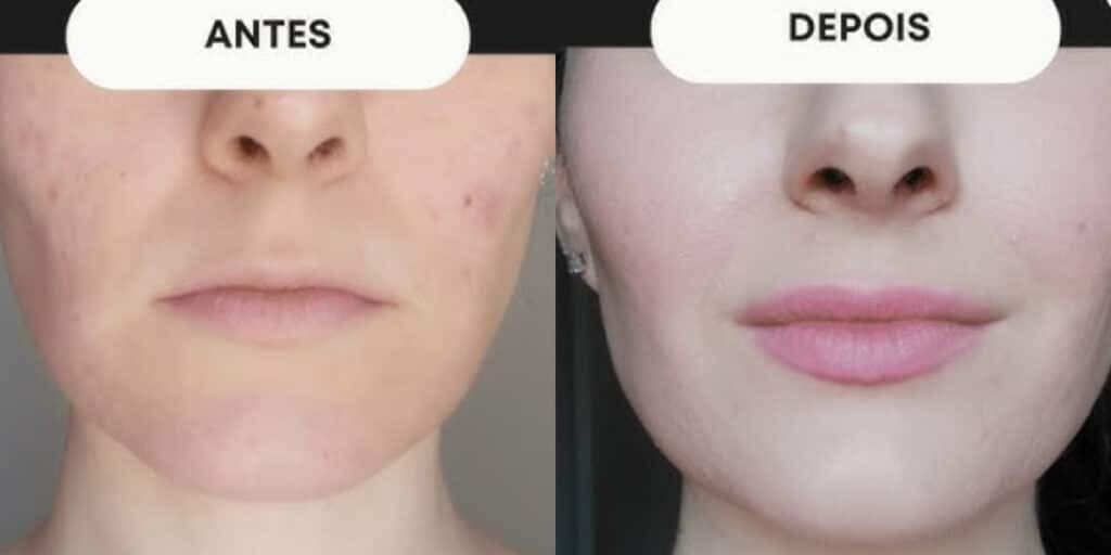 Fim do rosto caído e rugas: Harmonização facial caseira rejuvenesce 10 anos em apenas 10 minutos