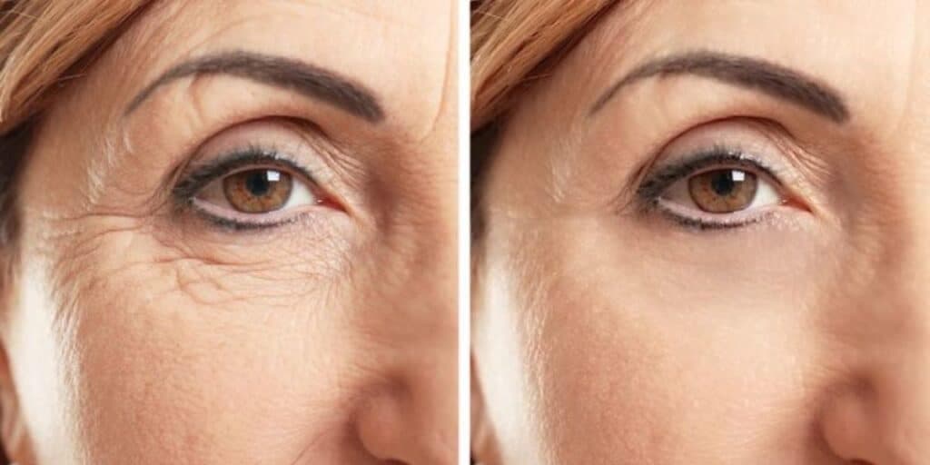 Harmonização facial caseira: Segredinho com resultado imediato traz pele firme e fim das rugas em 10 minutos