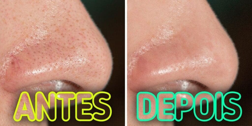 Pele de bebê garantida e resultado IMEDIATO: 4 dicas INFALÍVEIS para fechar os poros do rosto em casa