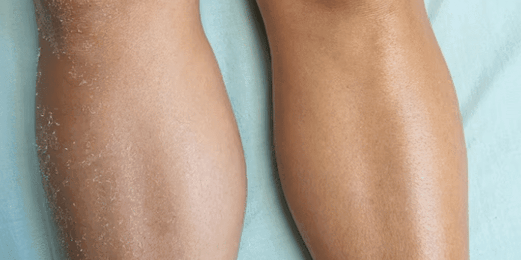 Resultado IMEDIATO: Misturinha caseira com leite e +2 ingredientes dá fim às pernas ressecadas de mulheres