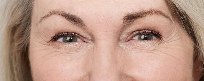 Pés de galinha na região dos olhos (Foto: Divulgação)