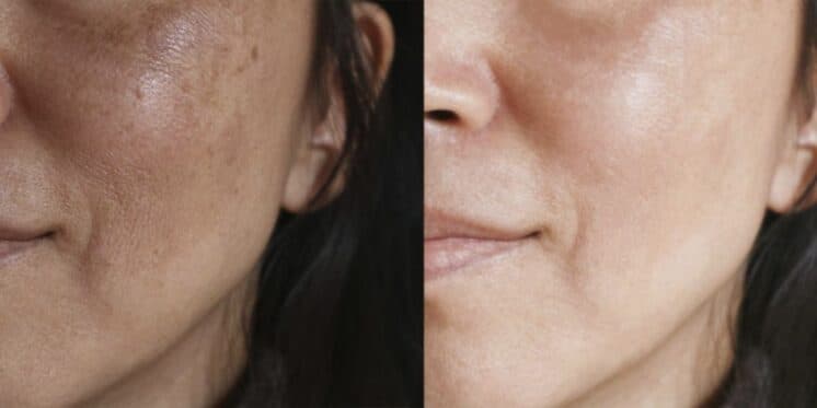 Efeito de botox e de graça: Misturinha com 2 ingredientes acaba com as manchas escuras e traz pele de seda