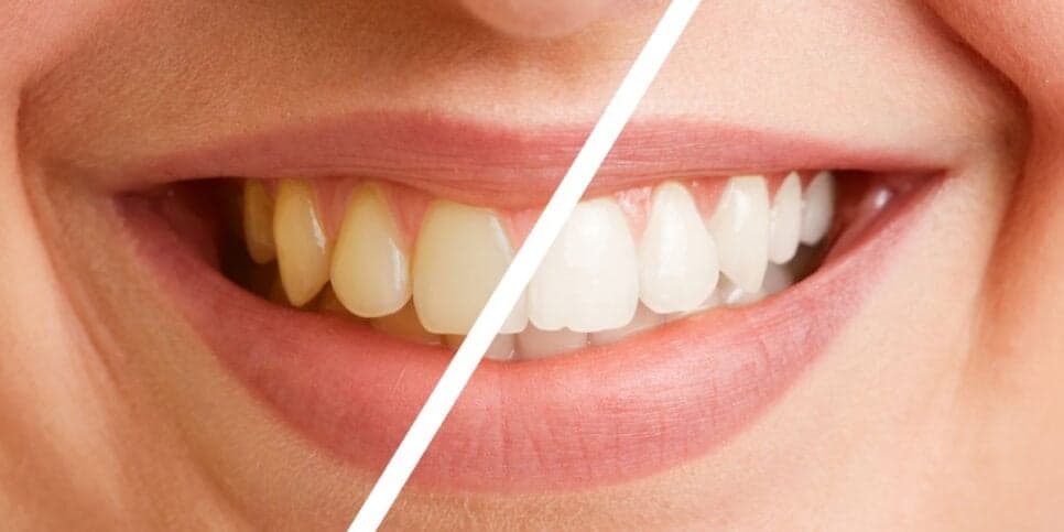Fim dos dentes amarelados e sem gastar com dentista: Misturinha com 2 ingredientes traz clareamento natural