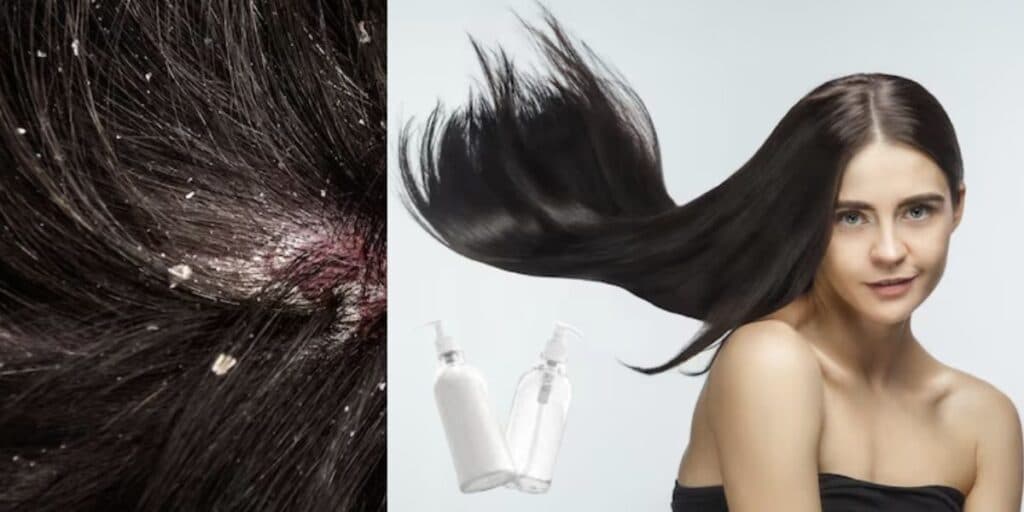 Suga as caspas e detona o frizz: Tônico caseiro com 2 ingredientes deixa cabelo mais brilhante que diamante