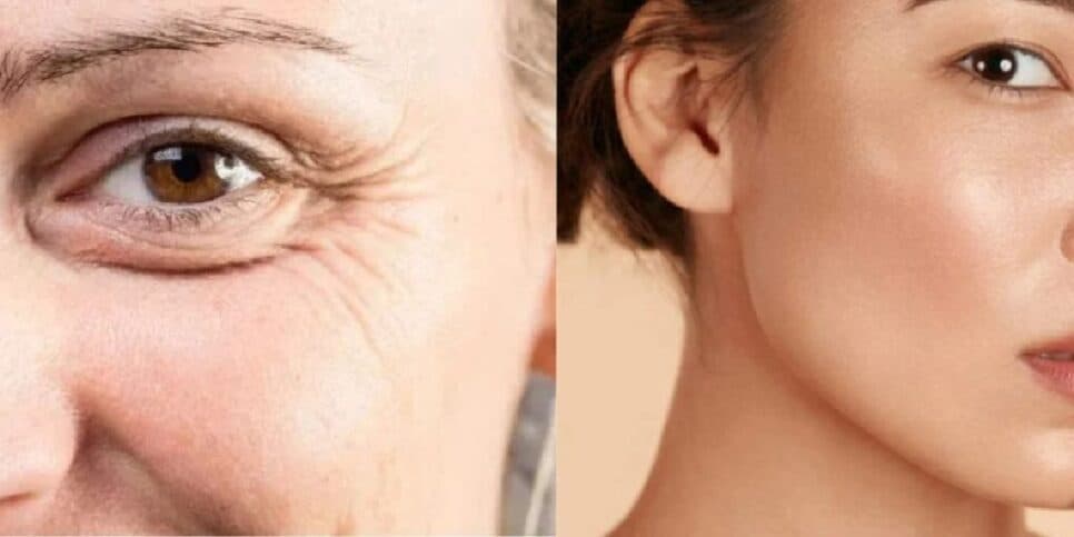 Efeito preenchimento e carinha de 20: Misturinha com 2 ingredientes suga rugas profundas dos olhos e boca