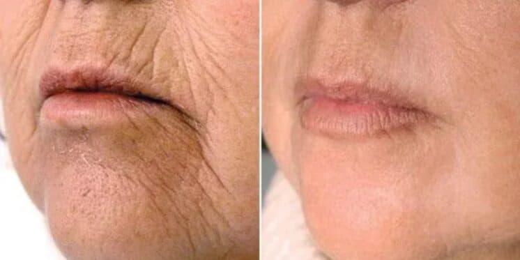 Suga 20 anos de rugas: Receitinha com 6 ingredientes rejuvenesce a pele de mulheres 40+ de dentro para fora
