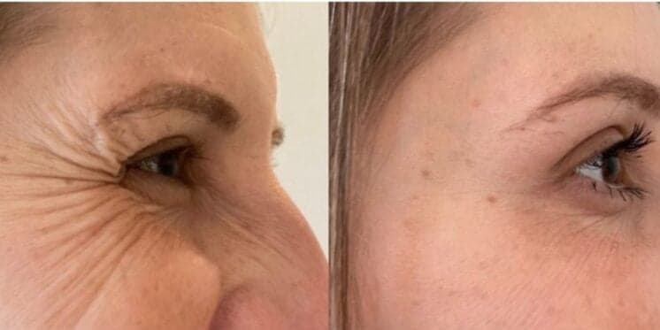 Adeus clínicas de estética: Botox caseiro elimina rugas e linhas de expressão com 2 ingredientes baratinhos