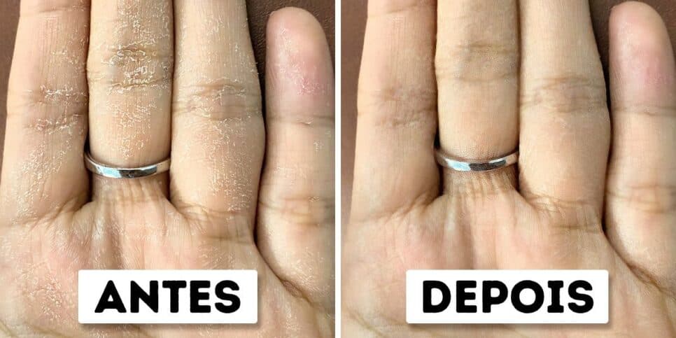 Para rejuvenescer: Receita com 3 ingredientes para dar adeus ao ressecamento e aos calos nas mãos