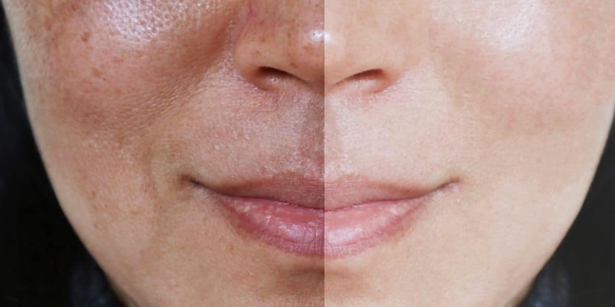 Rosto após dar adeus a melasma (Reprodução: Internet)